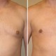 Gynecomastia Before & After Photos