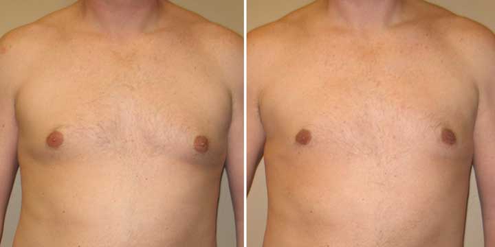 Gynecomastia Before & After Photos