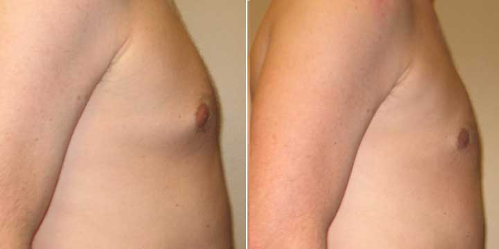 Gynecomastia Before & After Photos