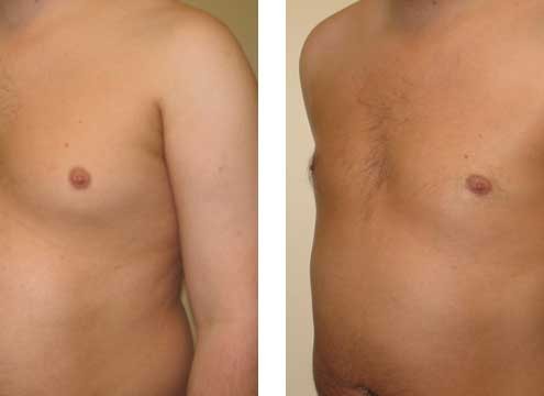 Gynecomastia Before and After Photo
