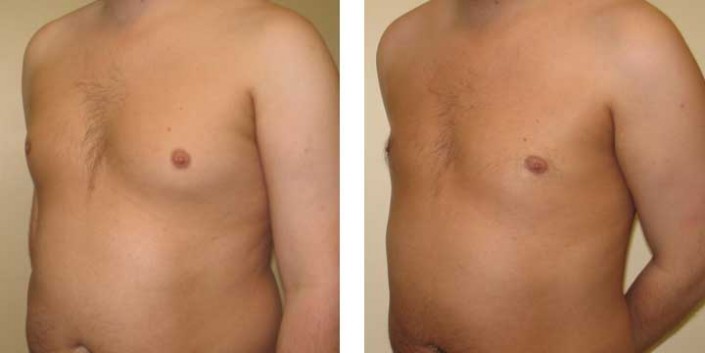 Gynecomastia Before and After Photo