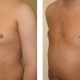 Gynecomastia Before and After Photo