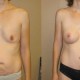 Mommy Makeover Before & After Photo
