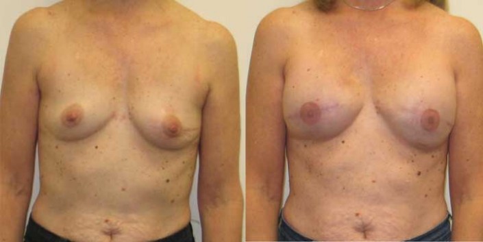 Breast Reconstruction Before and After