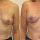 Breast Reconstruction Before and After