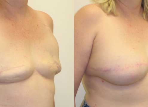 Breast Reconstruction Before and After Photo
