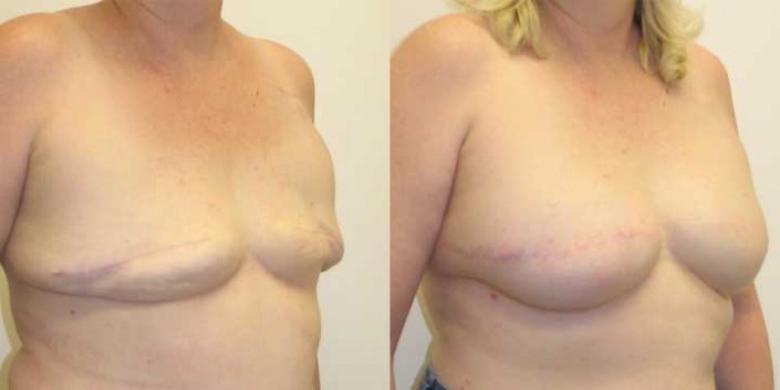 Breast Reconstruction Before and After Photo