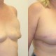 Breast Reconstruction Before and After Photo