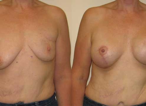 Breast Reconstruction Before and After Picture