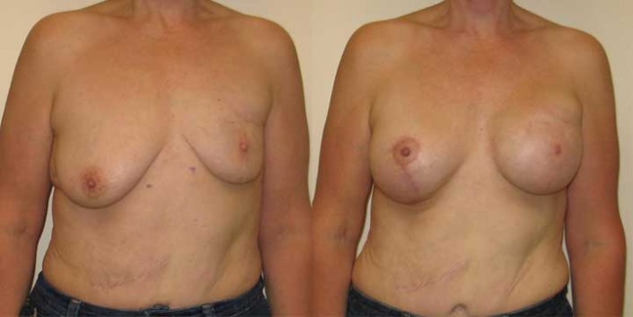 Breast Reconstruction Before and After Picture