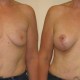 Breast Reconstruction Before and After Picture