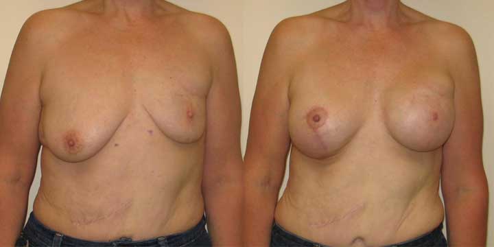 Breast Reconstruction Before and After Picture