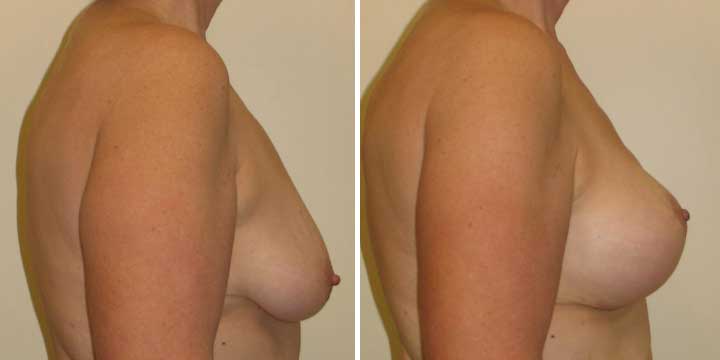 Breast Reconstruction Before and After Picture