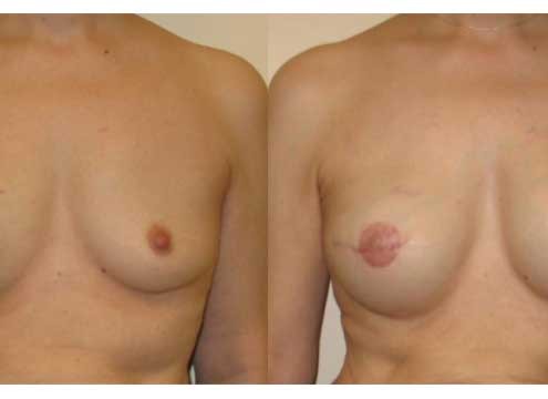 Breast Reconstruction Before and After Images