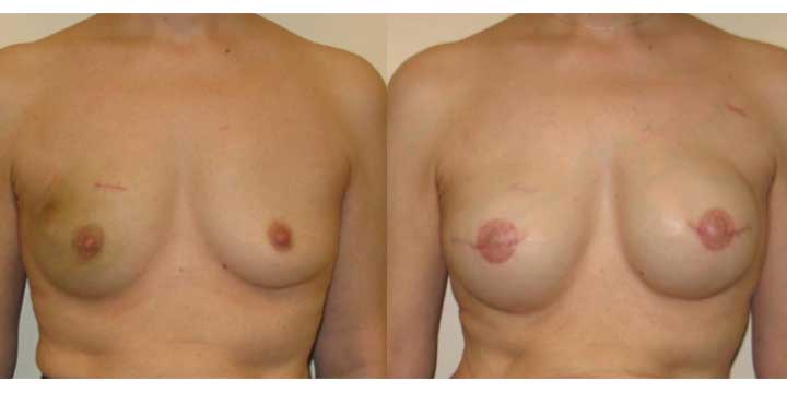 Breast Reconstruction Before and After Images