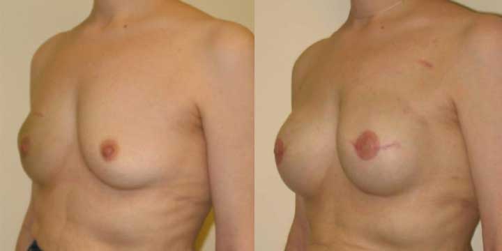 Breast Reconstruction Before and After Images