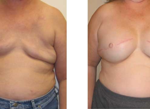 Breast Reconstructive Surgery Before and After