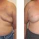 Breast Reconstructive Surgery Before and After