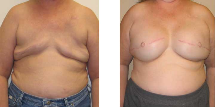 Breast Reconstructive Surgery Before and After