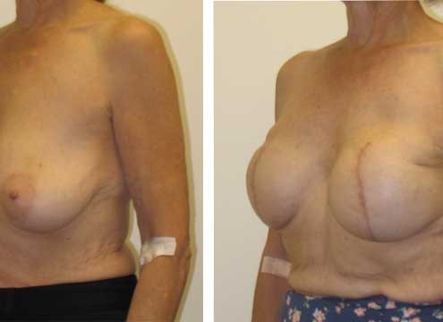 Breast Recontruction Surgery Before and After Images