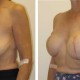 Breast Recontruction Surgery Before and After Images