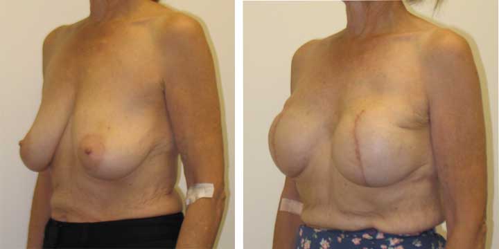 Breast Recontruction Surgery Before and After Images