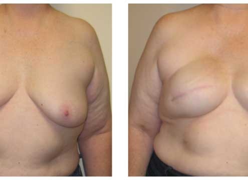 Breast Reconstruction Before and After Images