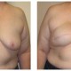 Breast Reconstruction Before and After Images