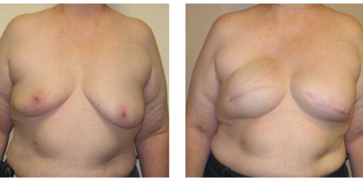 Breast Reconstruction Before and After Images