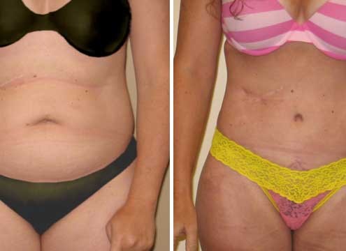 Tummy Tuck Before & After Photo