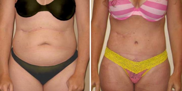 Tummy Tuck Before & After Photo