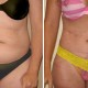 Tummy Tuck Before & After Photo