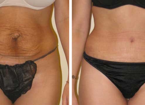 Tummy Tuck Before & After