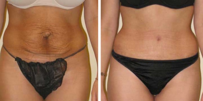 Tummy Tuck Before & After