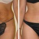 Tummy Tuck Before & After