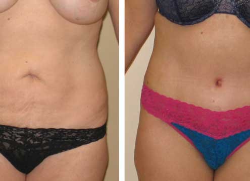 Tummy Tuck Before & After Photo