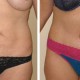 Tummy Tuck Before & After Photo