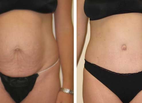 Tummy Tuck Before & After Photo