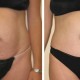 Tummy Tuck Before & After Photo