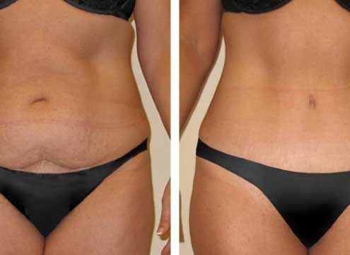 Tummy Tuck Before & After case