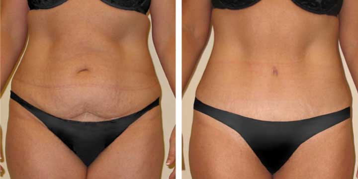 Mini Tummy Tuck Tampa - Mini Tummy Tuck Surgery Tampa Bay Florida