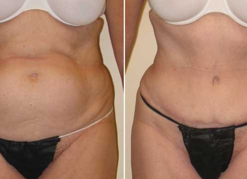 Tummy Tuck Before & After Photo