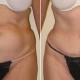 Tummy Tuck Before & After Photo