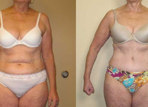 Tummy Tuck Before & After Photo