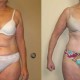 Tummy Tuck Before & After Photo