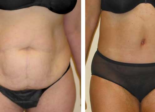 Tummy Tuck Before & After Photo