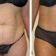 Tummy Tuck Before & After Photo