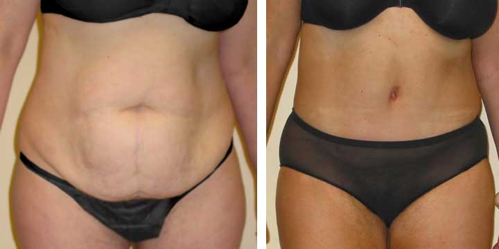 Tummy Tuck Before & After Photo