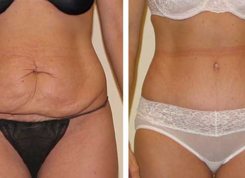 Tummy Tuck Before & After Photo