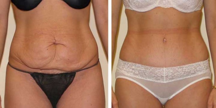 Tummy Tuck Before & After Photo